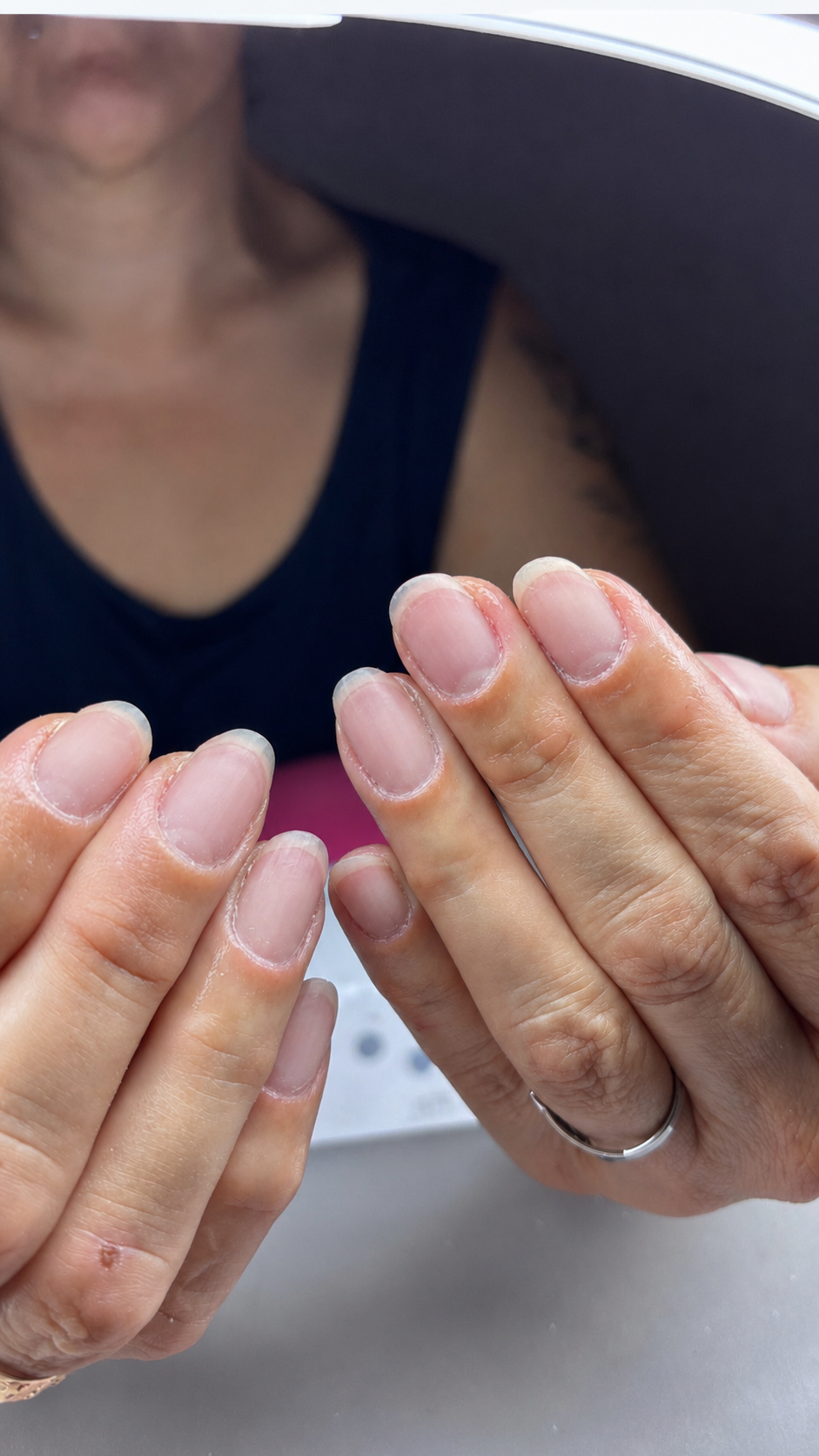 Uñas antes del tratamiento