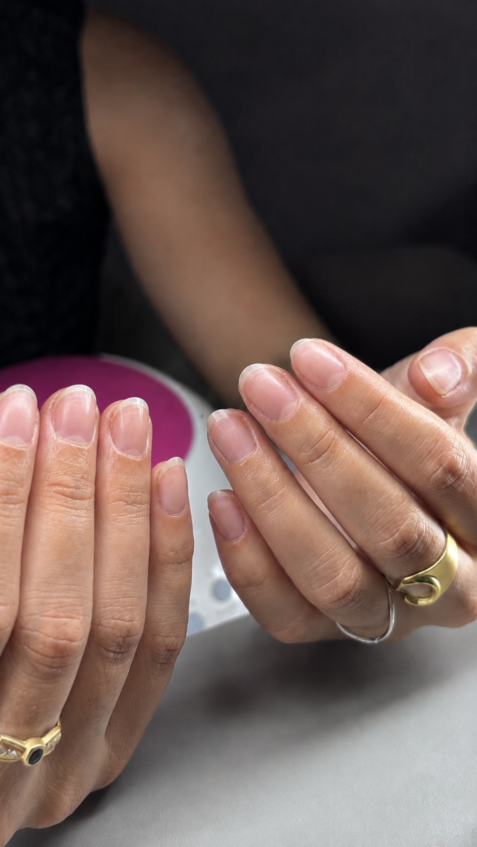 Uñas antes del tratamiento